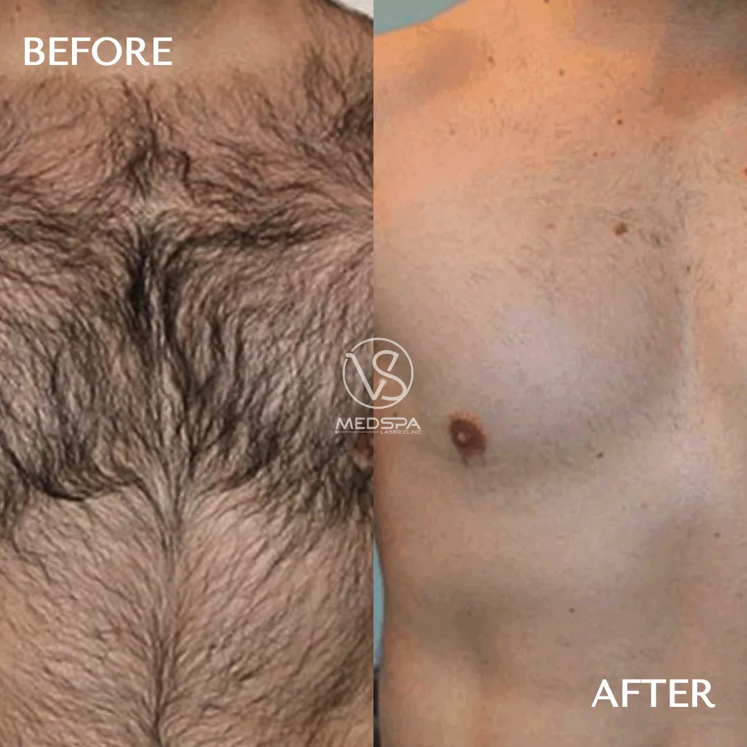 VS MedSpa full body laser hair removal before and after chest VS MedSpa full body laser hair removal before and after chest