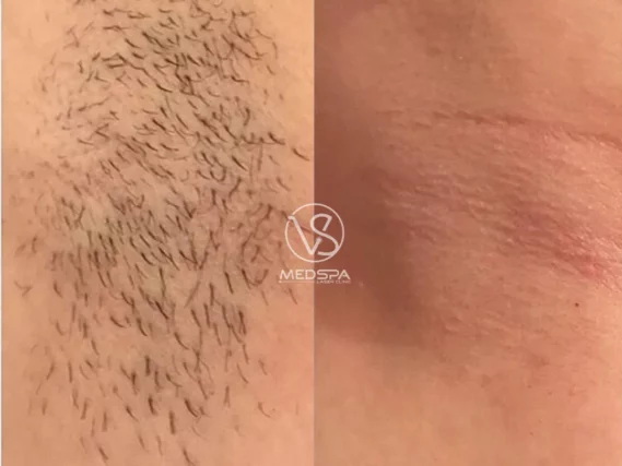 VS MedSpa full body laser hair removal before and after armpits