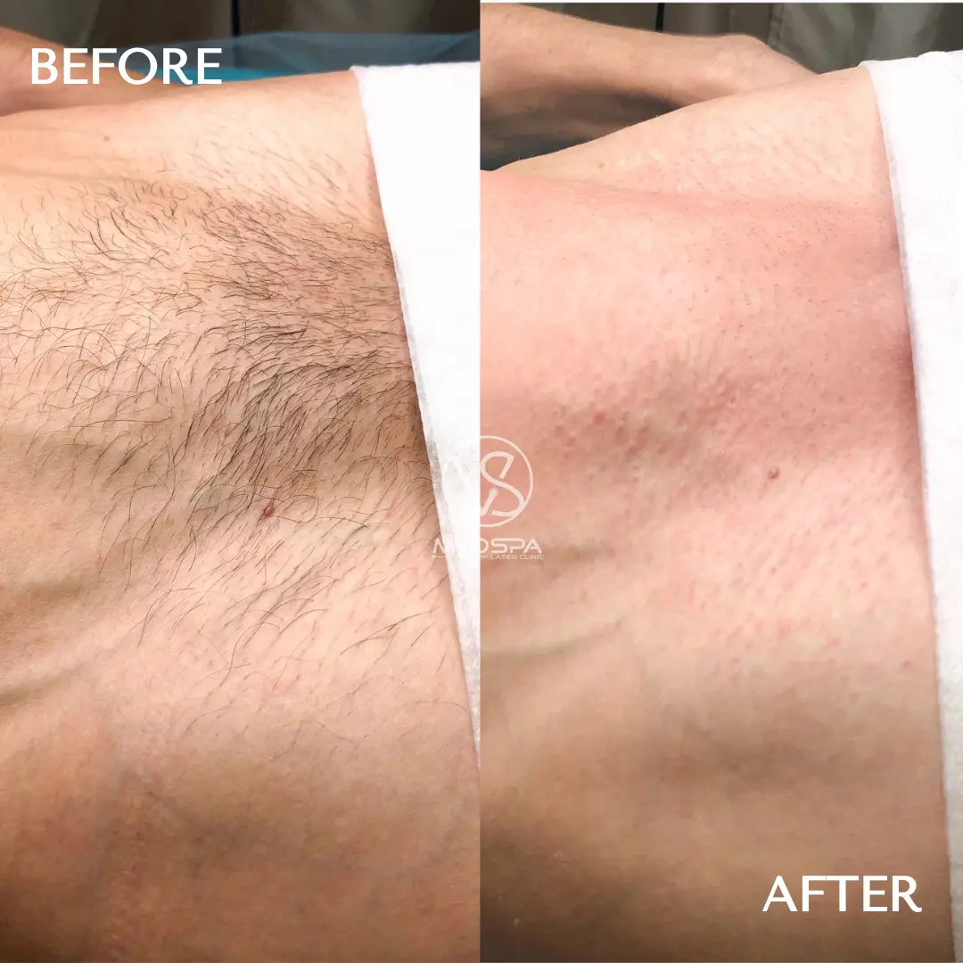 VS MedSpa male laser hair removal before and after manzilian