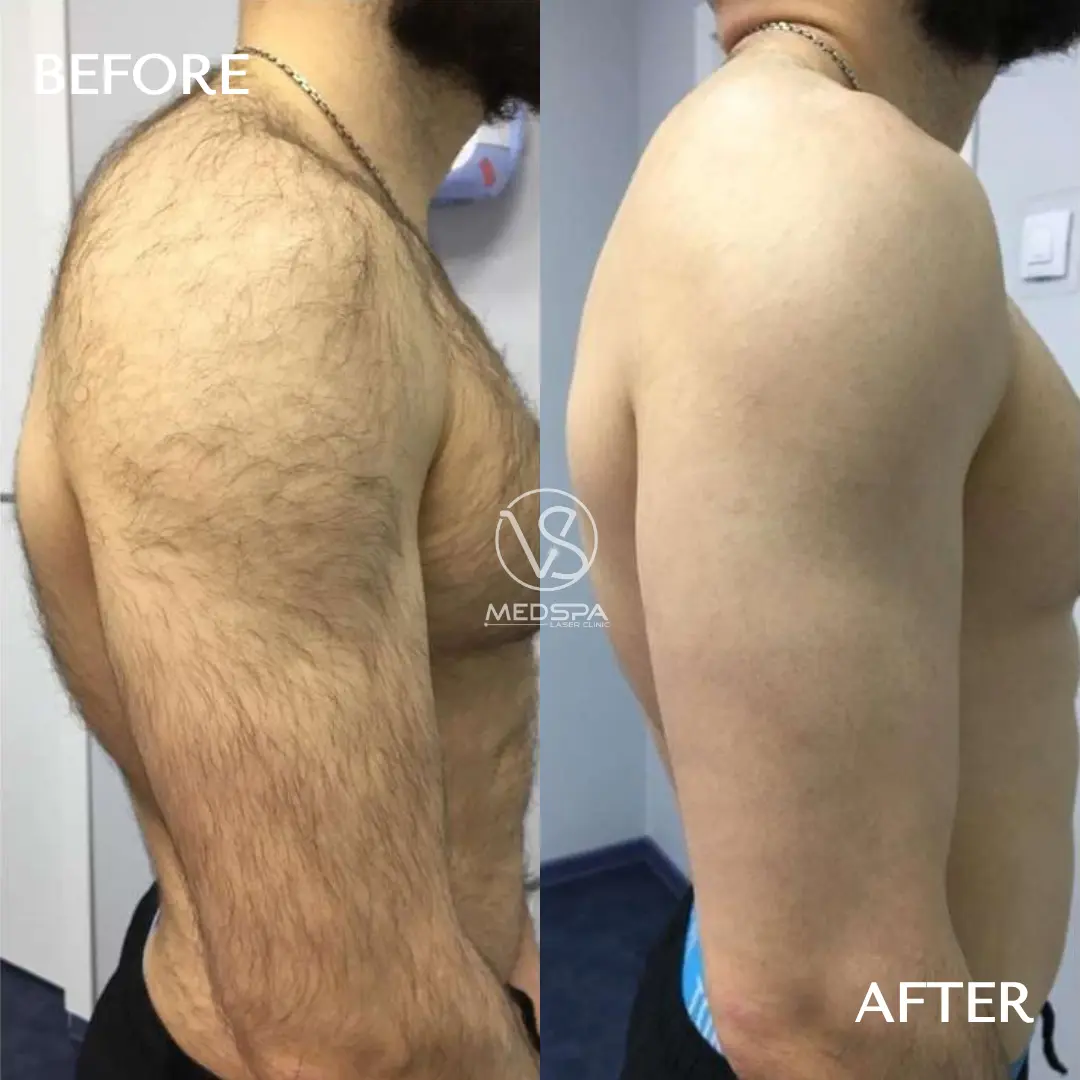 men laser hair removal before and after shoulders