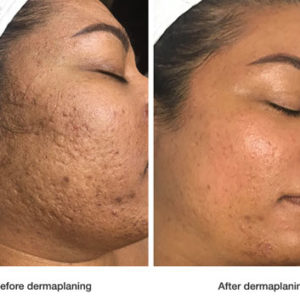 before-and-after-dermaplaning