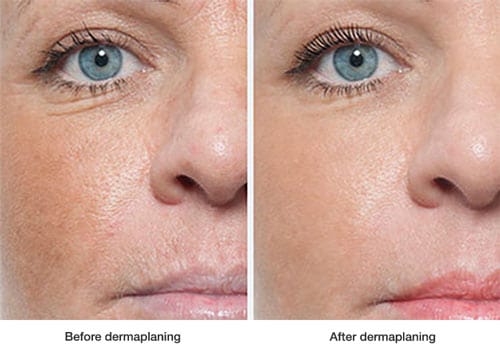 before-and-after-dermaplaning