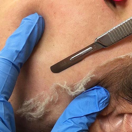 dermaplaning-procedure