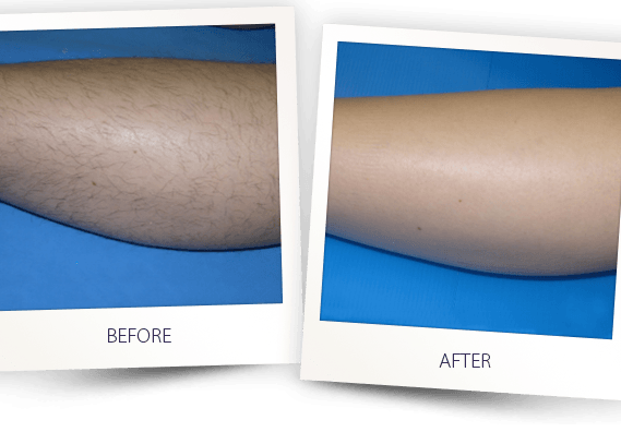 laser hair removal leg before after laser hair removal leg before after