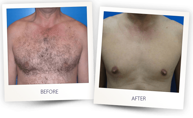laser hair removal men chest before after