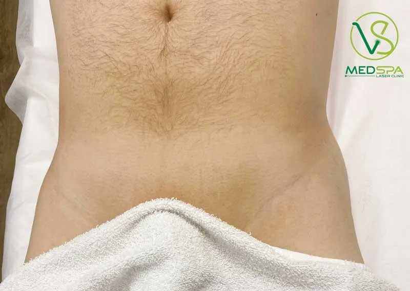 male-brazilian-laser-hair-removal-before-and-after-1 manzilian laser before and after