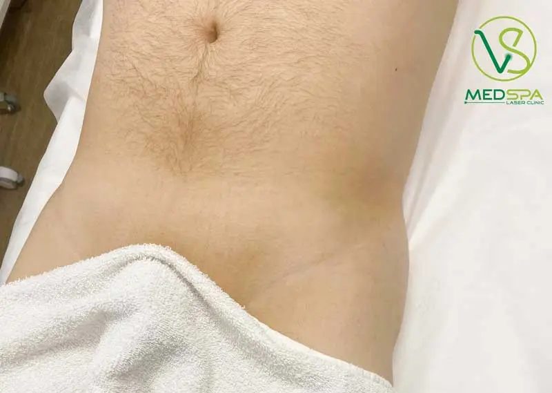 male-brazilian-laser-hair-removal-before-and-after-2 Toronto manzilian laser before and after