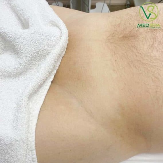 male-brazilian-laser-hair-removal-before-and-after-3 manzilian laser Toronto before and after