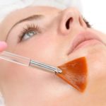 Chemical Peel
