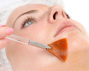 Chemical Peel