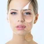 fractional laser