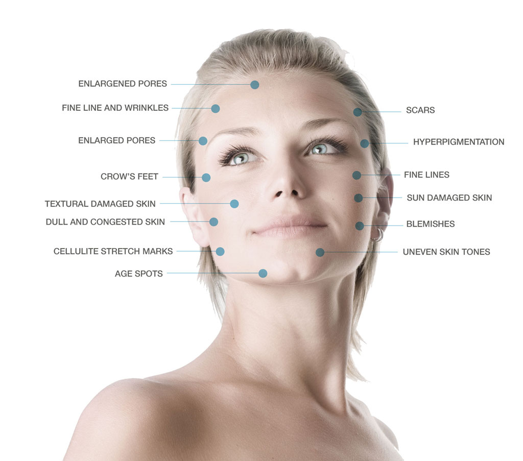 Microdermabrasion-benefits Microdermabrasion benefits