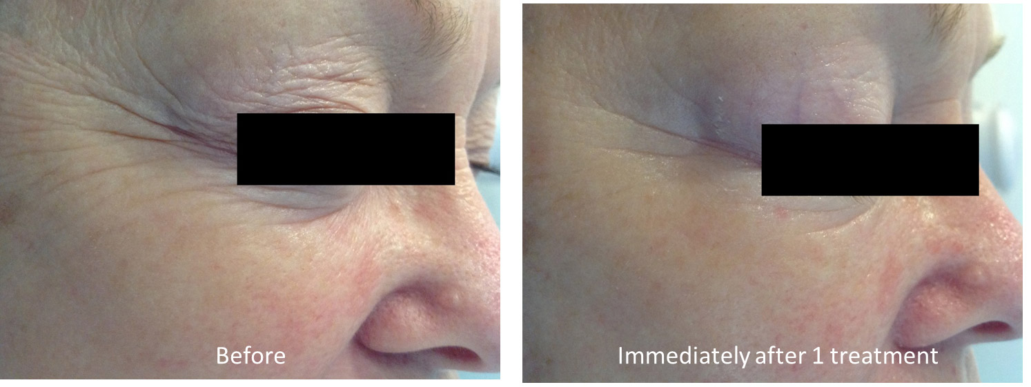 oxygeneo before and after