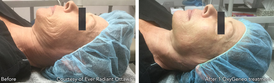 oxygeneo before and after photos
