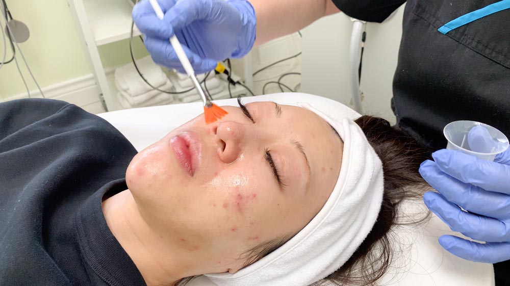 chemical peels acne treatment