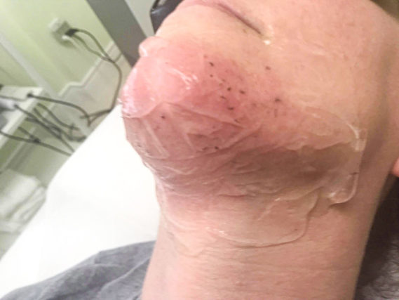 Chin Face laser hair removal before & after