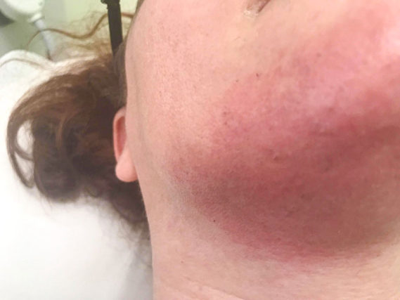Face laser hair removal on chin before & after
