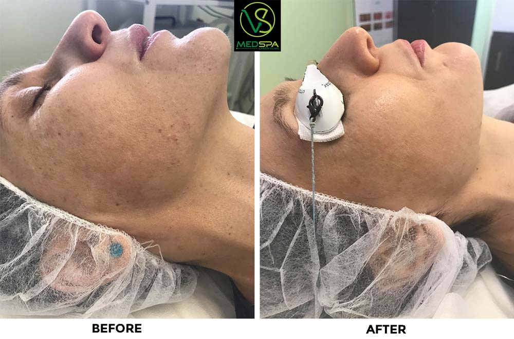 ipl-photo-facial-before-after ipl photo facial before after results