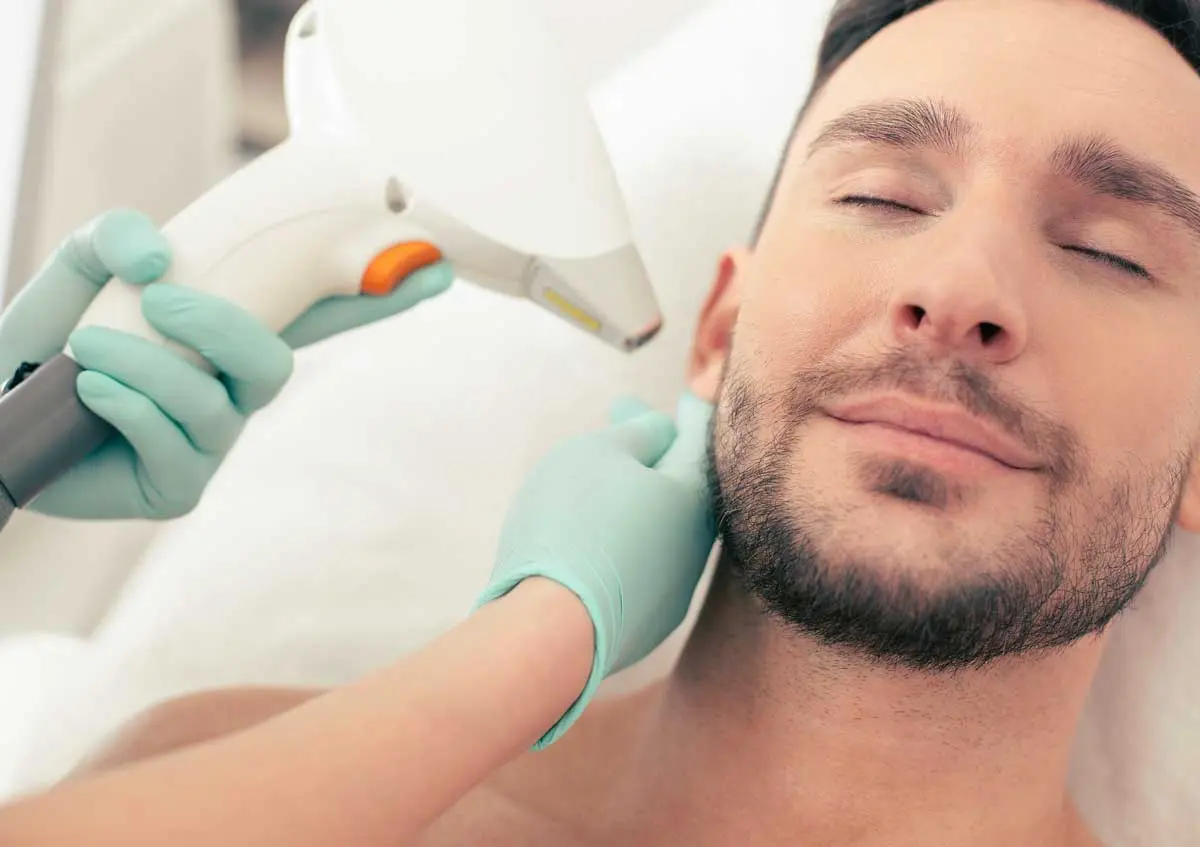 facial laser hair removal for mens beard