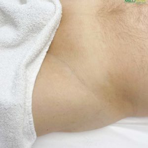 Full Brazilian for men