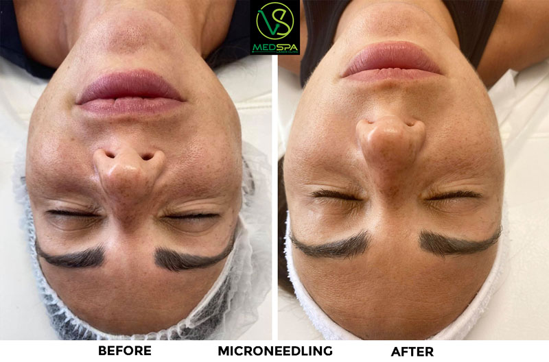 microneedling-facial-before-and-after-1 microneedling facial before and after