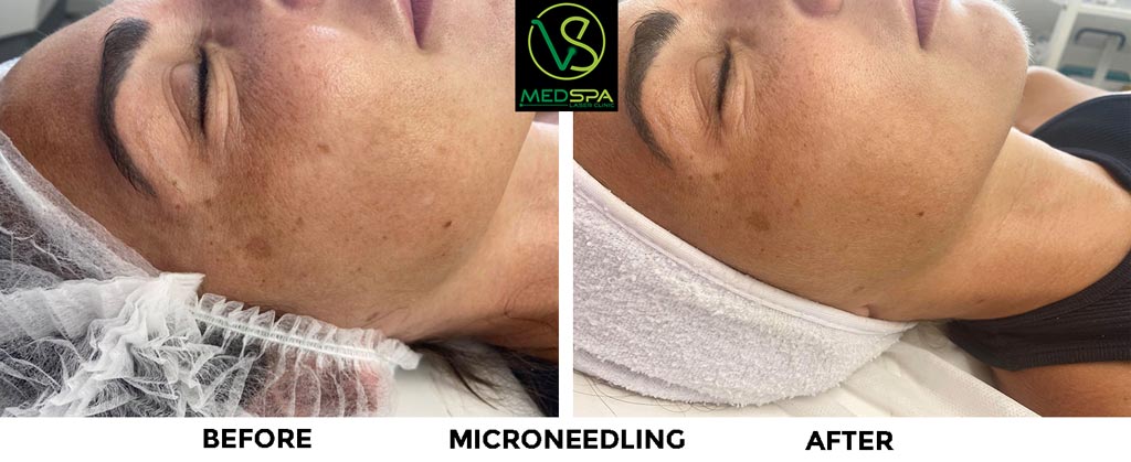 microneedling-facial-before-and-after-2 microneedling before and after results