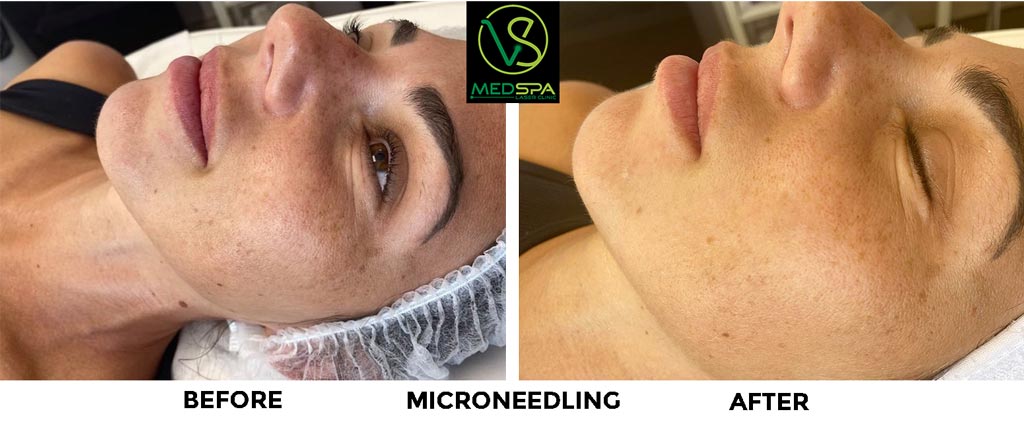 microneedling-facial-before-and-after-3 microneedling before and after