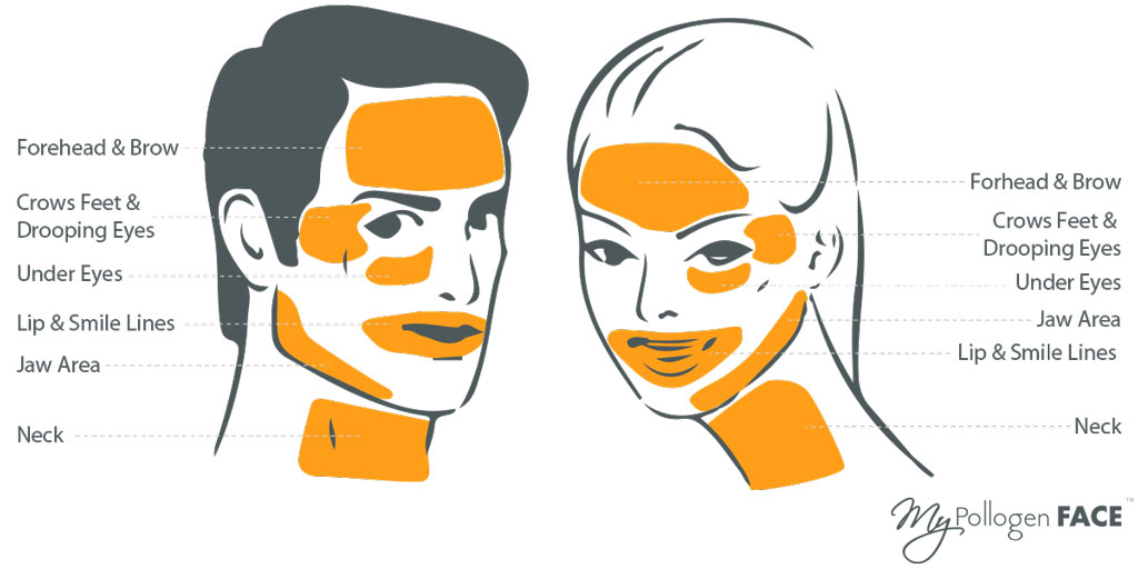 mypollogen-face-treatment-areas1 skin tightening face areas
