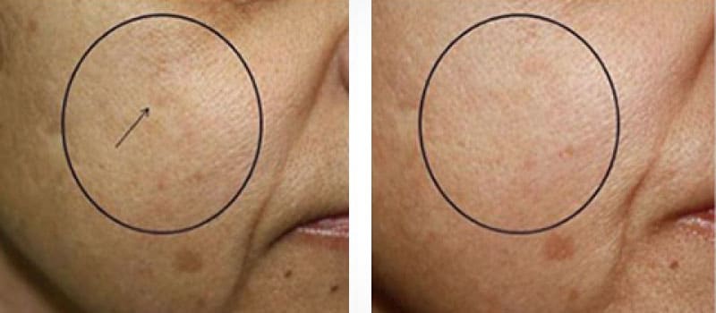 oxygeneo before and after scars