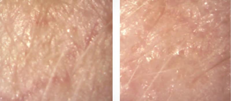 oxygeneo facial before after