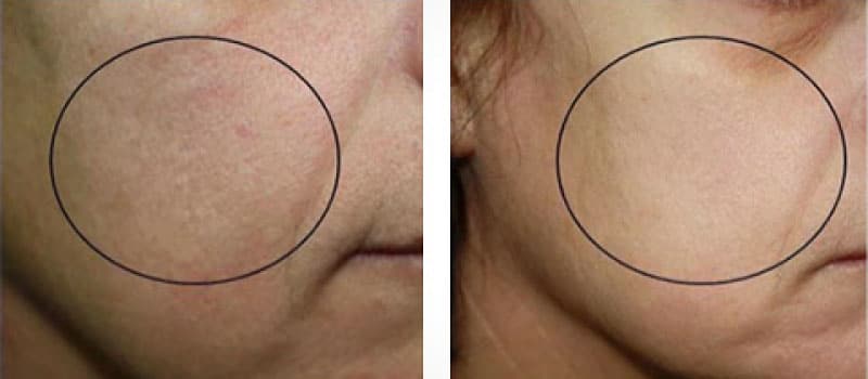 oxygeneo before and after redness