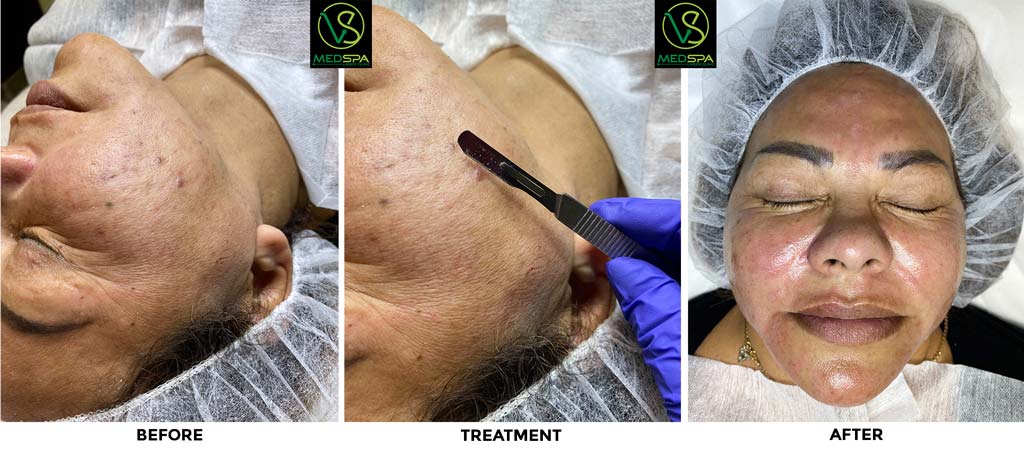 Dermaplaning before after frost