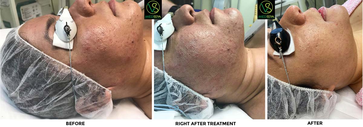 Fractional laser facial before & after Fractional laser facial before & after