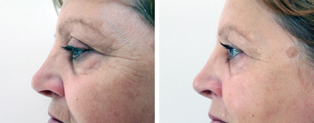 Fusion-before-and-after Fusion Meso before and after