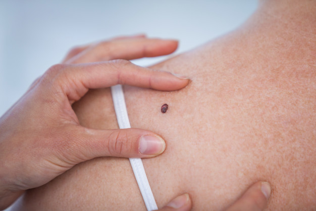 body mole removal
