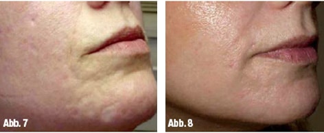 DERMAROLLER TREATMENT FOR SCARS DERMAROLLER TREATMENT FOR SCARS