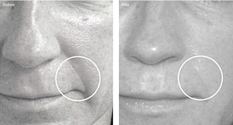 DERMAROLLER TREATMENT FOR WRINKLES DERMAROLLER TREATMENT FOR WRINKLES