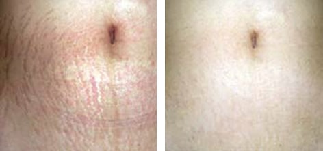 DERMAROLLER TREATMENT FOR STRETCH MARKS DERMAROLLER TREATMENT FOR STRETCH MARKS