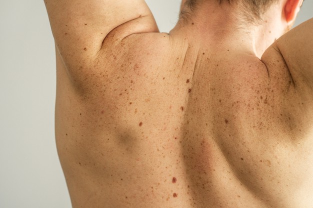 man back with scattered moles