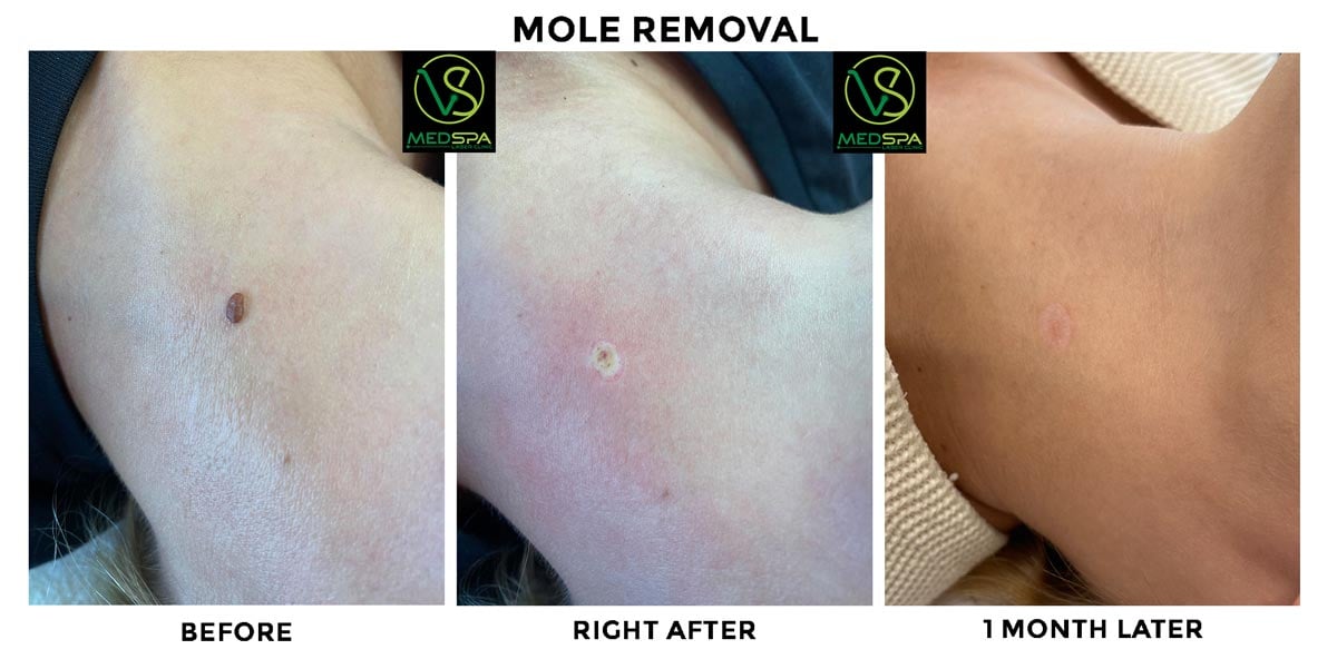 mole removal before and after