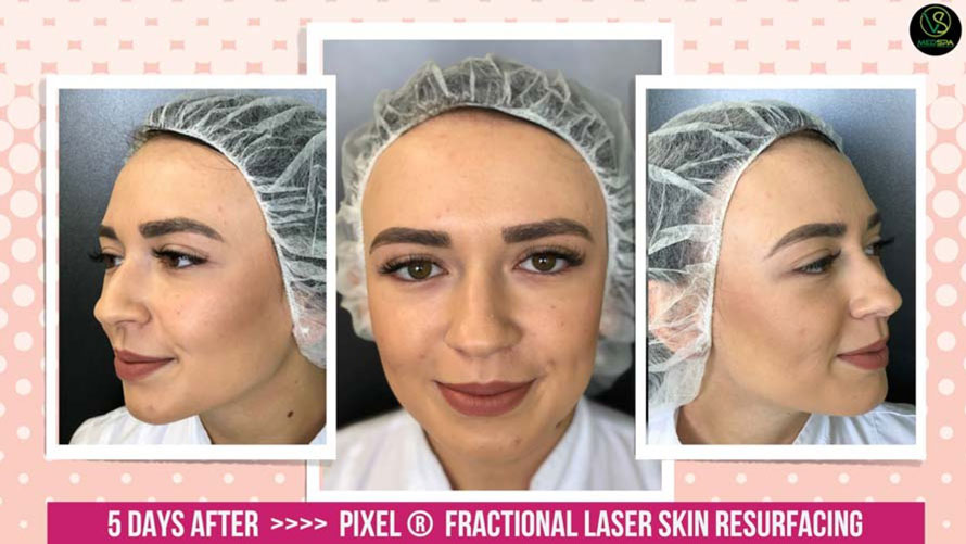 FRACTIONAL LASER SKIN RESURFACING 5 DAYS AFTER