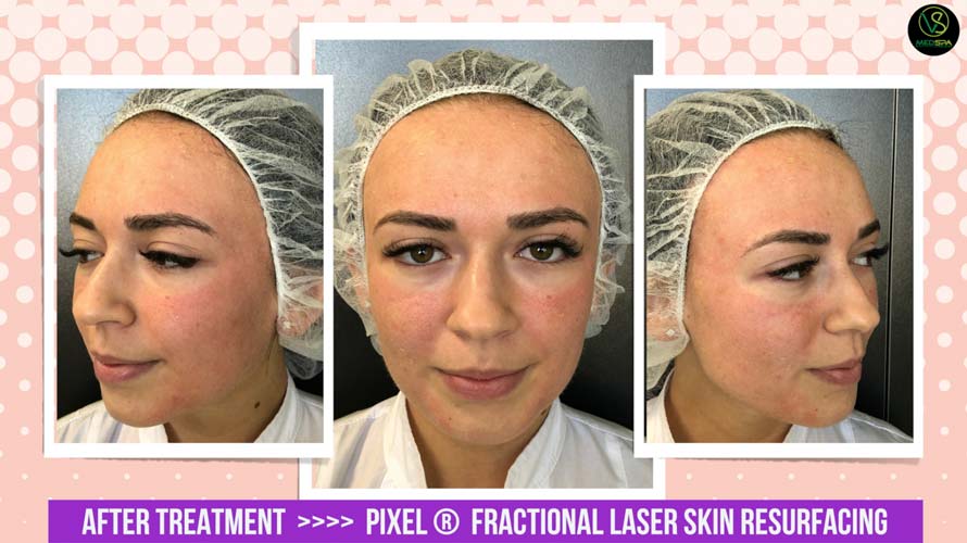 FRACTIONAL LASER SKIN RESURFACING AFTER
