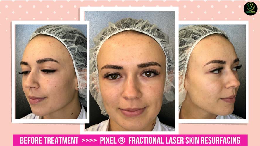 FRACTIONAL LASER SKIN RESURFACING BEFORE