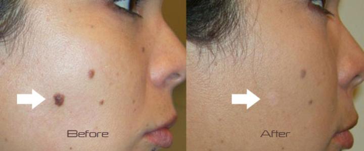 mole removal cosmetic results
