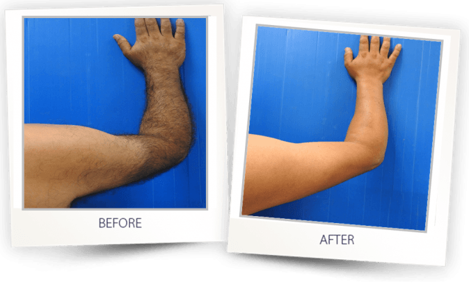 LASER HAIR REMOVAL ARMS BEFORE AFTER LASER HAIR REMOVAL ARMS BEFORE AFTER