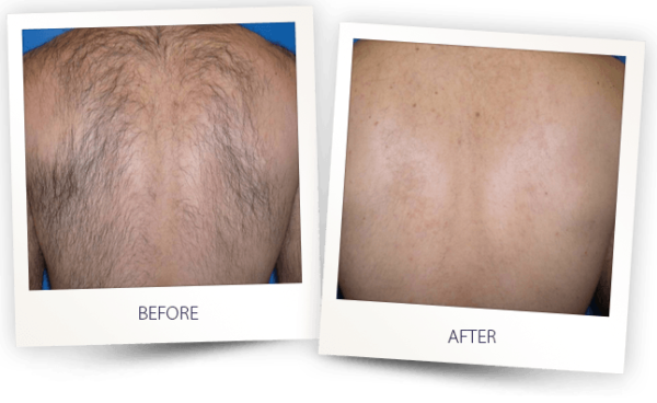 HAIR REMOVAL MEN BACK BEFORE AFTER
