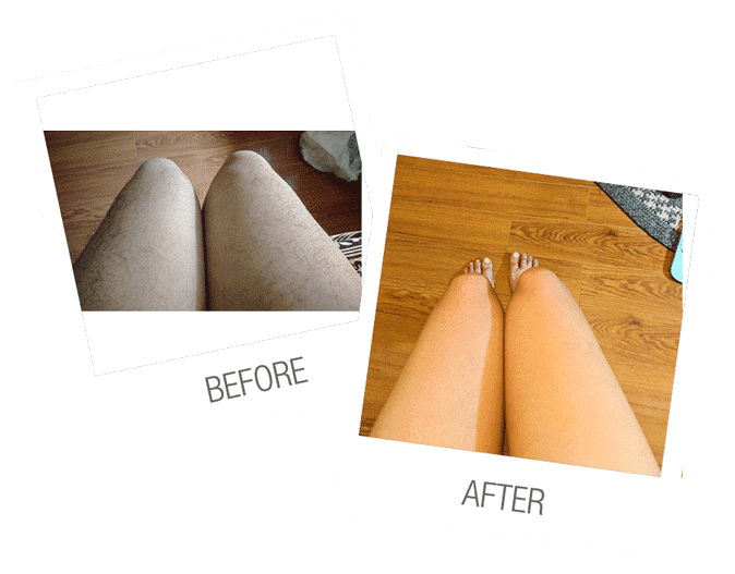 LASER-HAIR-REMOVAL-KNEES-BEFORE-AFTER LASER HAIR REMOVAL for women BEFORE AFTER legs