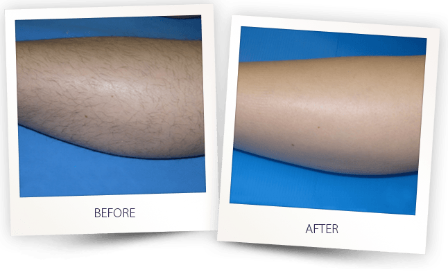 LASER HAIR REMOVAL LEG BEFORE AFTER LASER HAIR REMOVAL LEG BEFORE AFTER