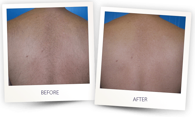 LASER HAIR REMOVAL MEN BACK BEFORE AFTER LASER HAIR REMOVAL MEN BACK BEFORE AFTER