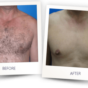 HAIR REMOVAL MEN CHEST BEFORE AFTER